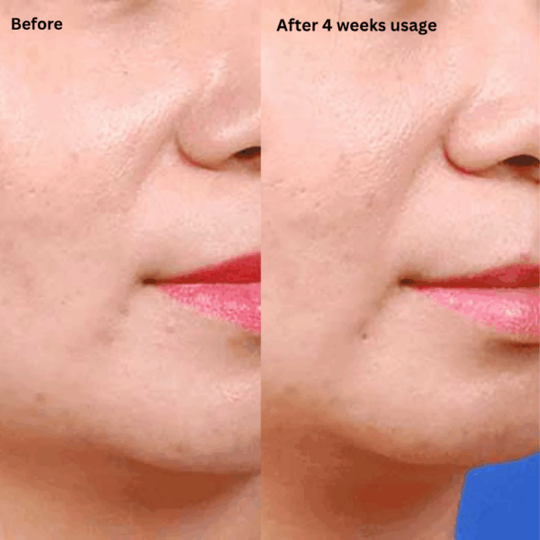 Before and after pictures after using calecim professional pigment solution for 4 weeks