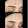 Image demonstrating dramatic improvements of acne-prone skin after using azelaic & kojic advanced clarifying serum for 56 days