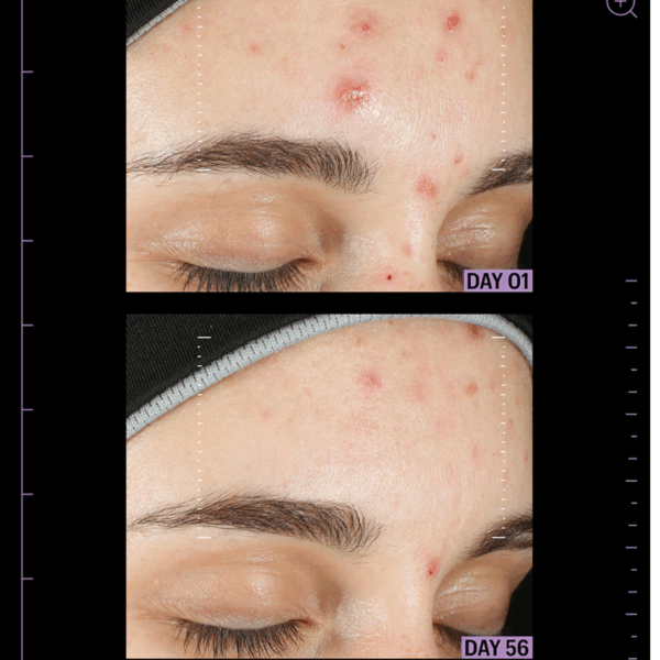 Image demonstrating dramatic improvements of acne-prone skin after using azelaic & kojic advanced clarifying serum for 56 days