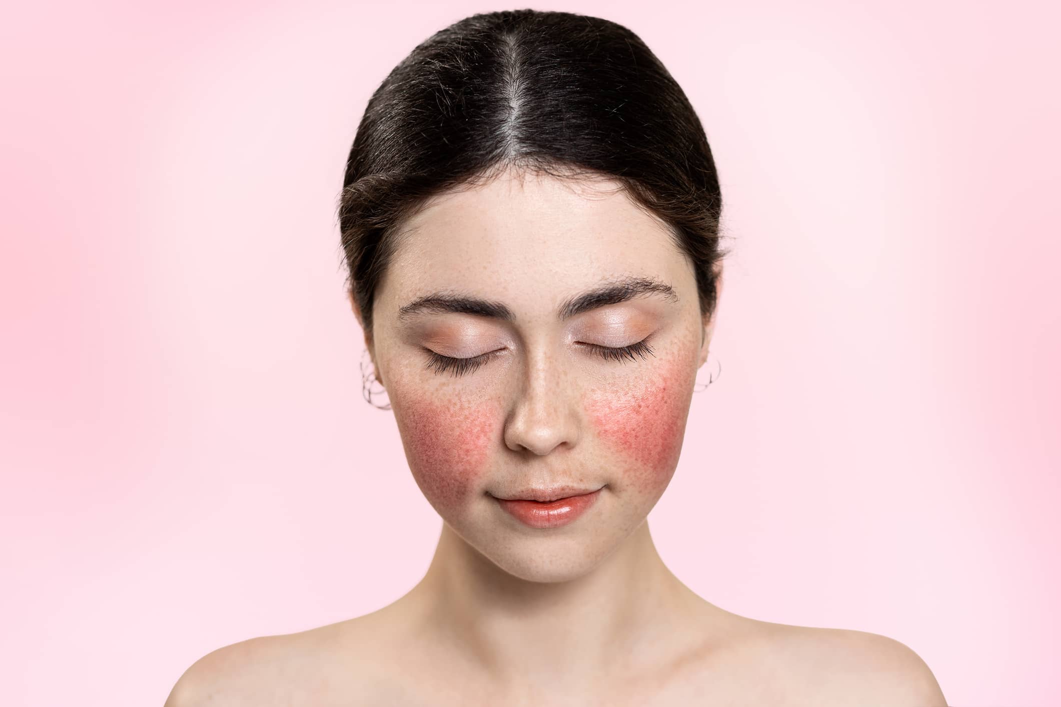 How to Get Rid of Rosacea