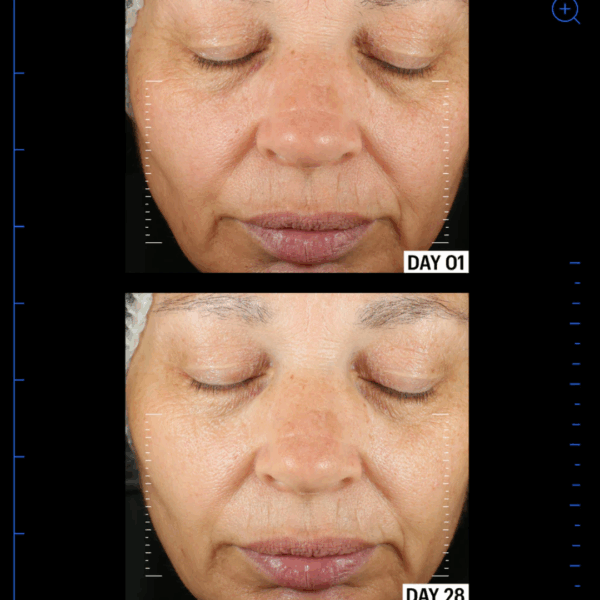Image showing reduced redness, more even skin tone after using allies of skin copper tripeptide & ectoin advanced repair serum for 28 days