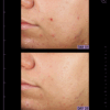 Image showing dramatic skin blemishes clearance after using allies of skin azelaic & kojic advanced clarifying serum for 28 days