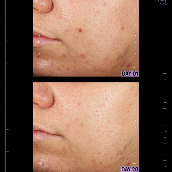 Image showing dramatic skin blemishes clearance after using allies of skin azelaic & kojic advanced clarifying serum for 28 days