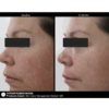 Before and after picture of a woman after using Image of all 6 products of jan marini skin care mangement system 6 steps for 10 months