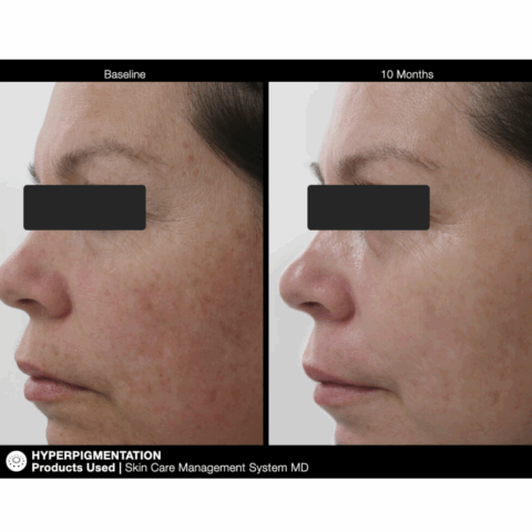 Before and after picture of a woman after using Image of all 6 products of jan marini skin care mangement system 6 steps for 10 months