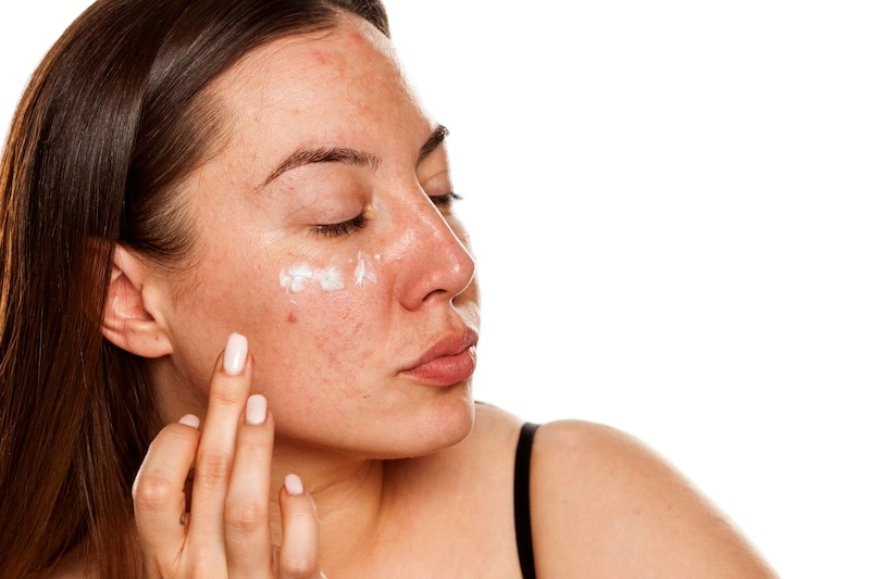 Woman Doing Adult Acne Treatment