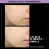 Visible skin improvement before and after using Allies Of Skin Azelaic And Kojic Advanced Clarifying Serum for uneven tone and blemishes