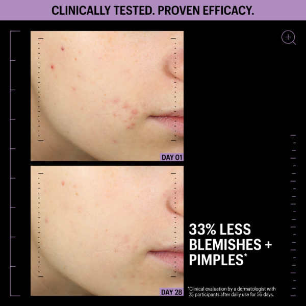 Visible skin improvement before and after using Allies Of Skin Azelaic And Kojic Advanced Clarifying Serum for uneven tone and blemishes