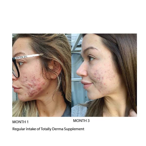 totally derma collagen before and after results