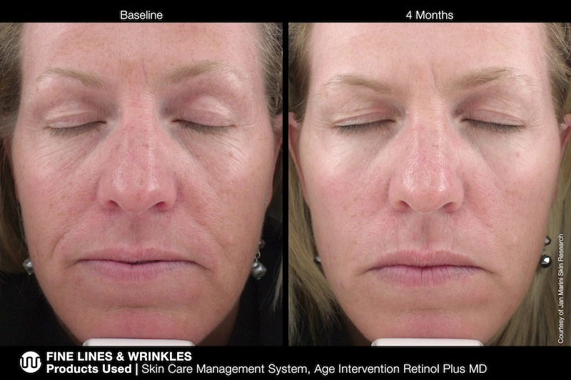 Before and After Using Jan Marini Skin Care Management System