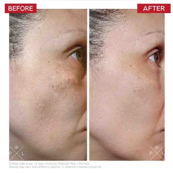 Dr levy before and after Reboot pro peel