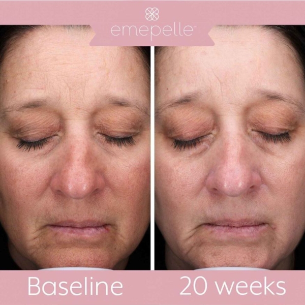 Emepelle Serum before and after results