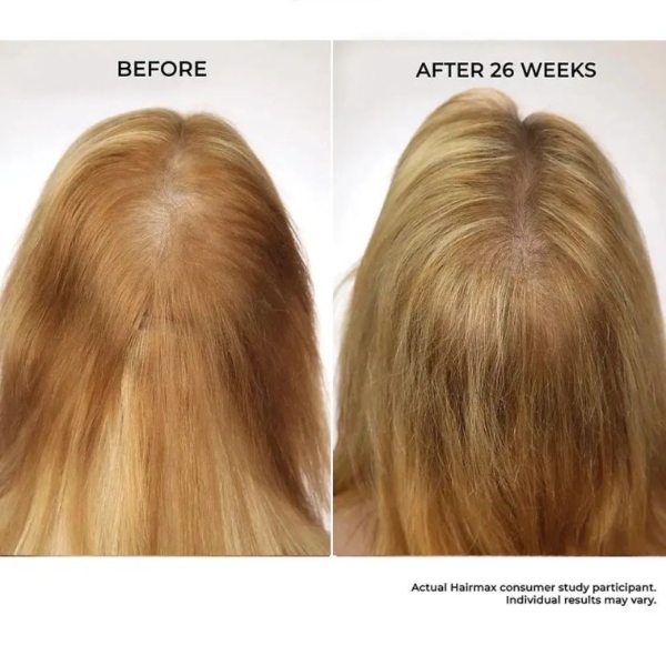 HairMax LaserBand 82