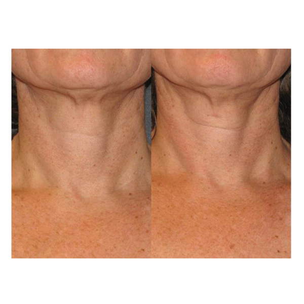 Neostrata Triple Firming Neck Cream Before and After