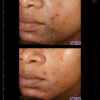 Image showing dramatic reduction of inflammation and blemishes after using azelaic & kojic advanced clarifying serum for 56 days