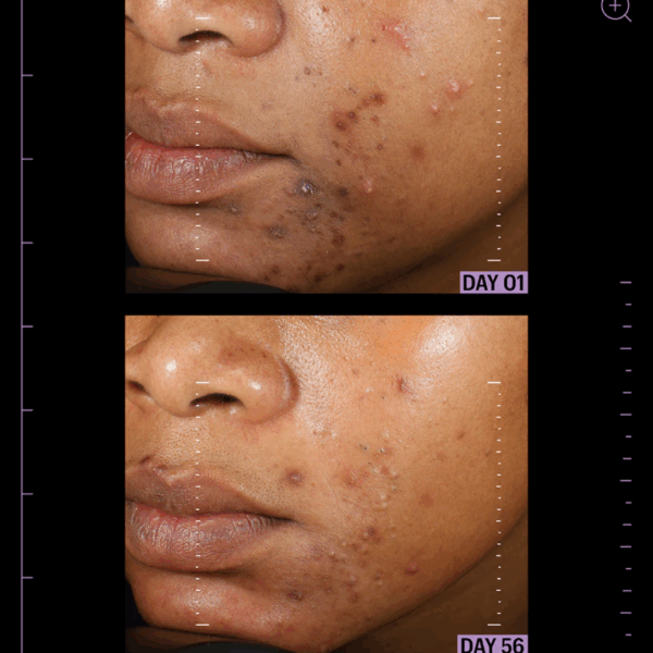 Image showing dramatic reduction of inflammation and blemishes after using azelaic & kojic advanced clarifying serum for 56 days