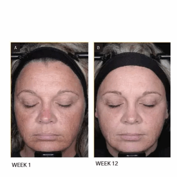 Before and after of a woman showing improved skin glow and firmness after using Lumity Morning and Night Female Refill