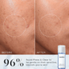 Before and after using Medik8 Press & Clear Refill 150ml showing reduced blemishes and improved skin clarity