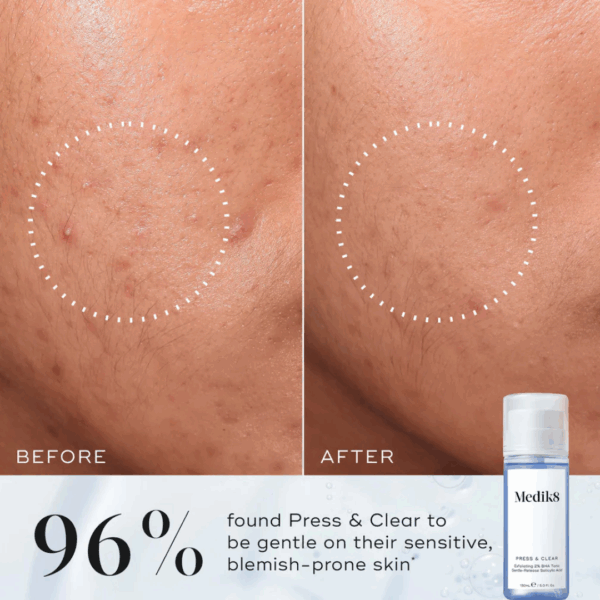 Before and after using Medik8 Press & Clear Refill 150ml showing reduced blemishes and improved skin clarity