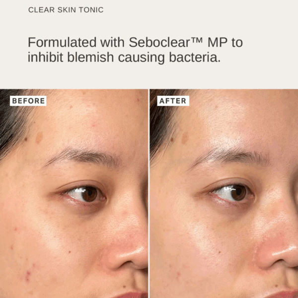 Before and after comparison showing improved skin clarity and reduced blemishes after using Alpha H Clear Skin Tonic