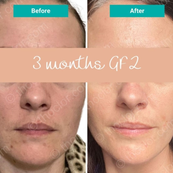 before and after thoclor gf2