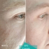 Thoclor gf2 skin rejuvenation before and after