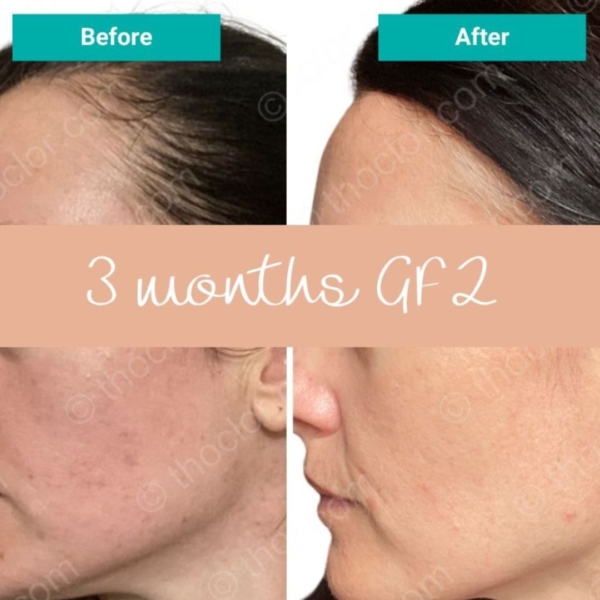 Thoclor gf2 results before and after