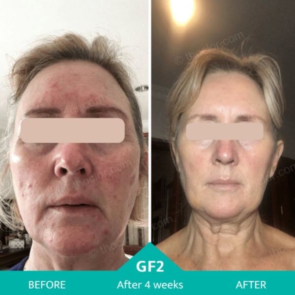 Thoclor gf2 before and after