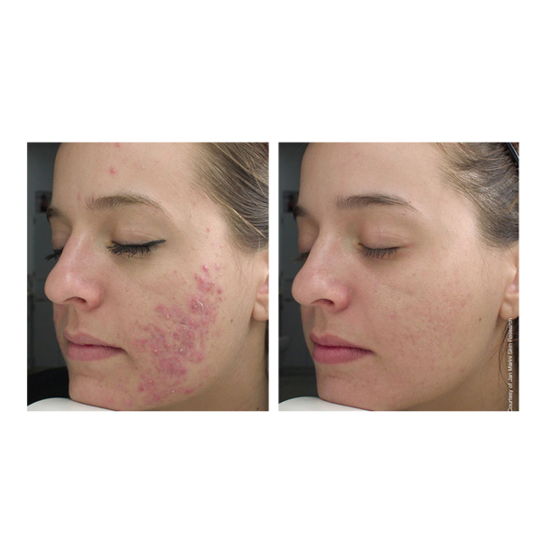 Jan Marini Bioclear before & after