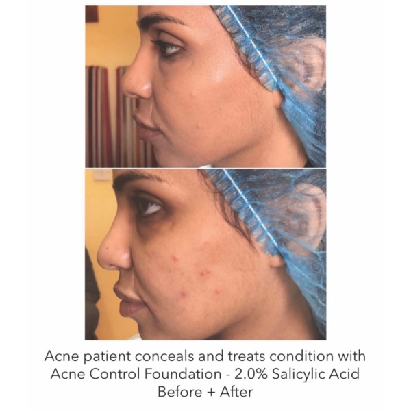 before after oxygenetix acne foundation 3 dermoi!