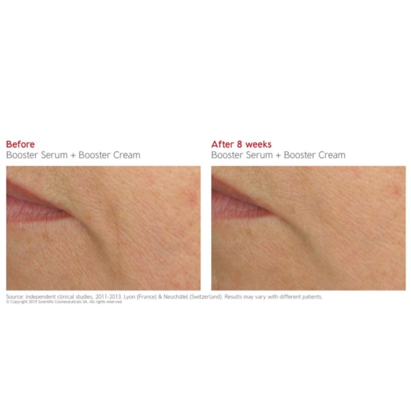 booster serum and cream before after 5 dermoi!