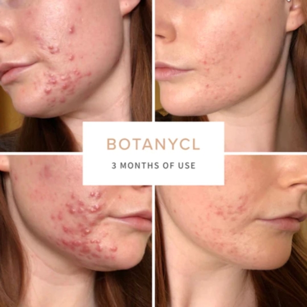 image of botanycl skin elixir before and after results