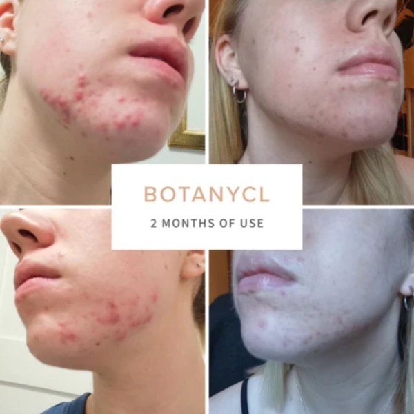 image of botanycl skinclear elixir before and after