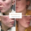 botanycl skinclear elixir before and after image