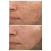 pca skin blemish control bar before and after