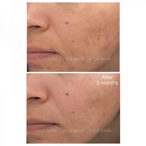 pca skin blemish control bar before and after