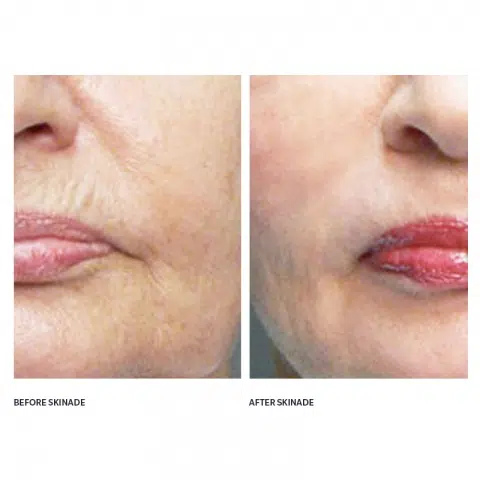 skinade before and after photos