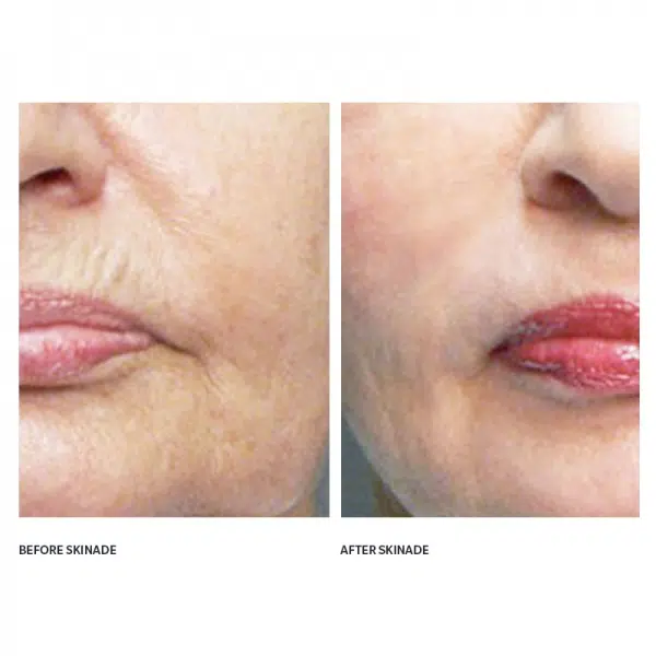 skinade before and after photos