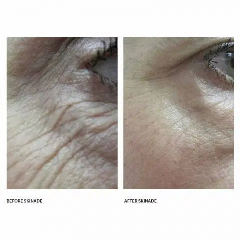 skinade collagen before and after