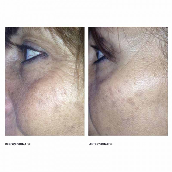 skinade before and after