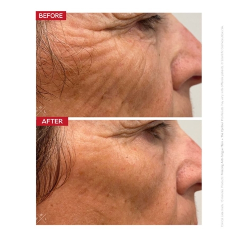 dr levy contour pro before and after