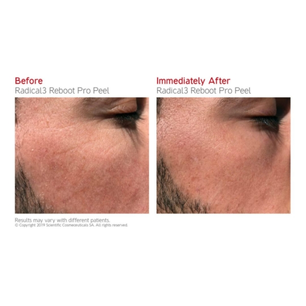 dr levy radical reboot pro peel before after dermoi!