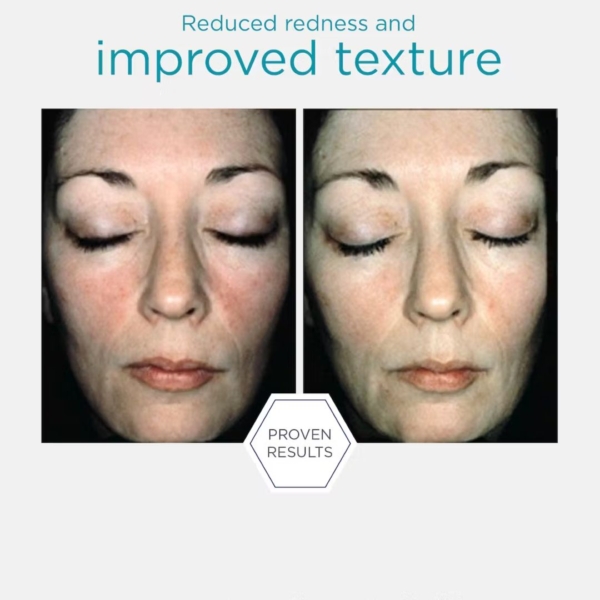 neostrata restore bionic face cream before and after dermoi!