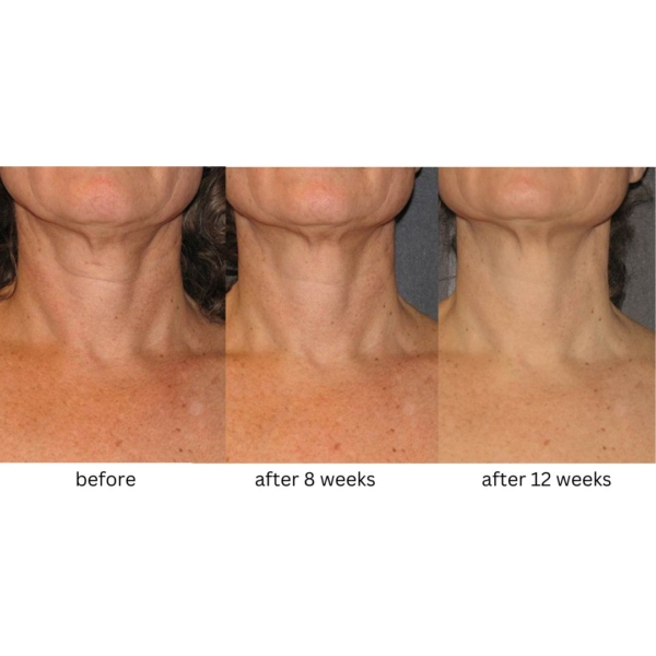 neostrata triple firming neck cream before after 1 dermoi!
