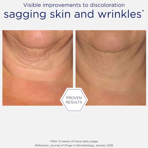 neostrata triple firming neck cream before after 2 dermoi!