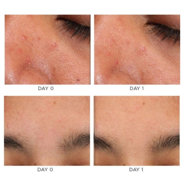 osmosis accelerate treatment before and after 1 dermoi!