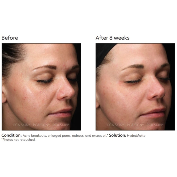 pca skin hydramatte moisturizer before and after