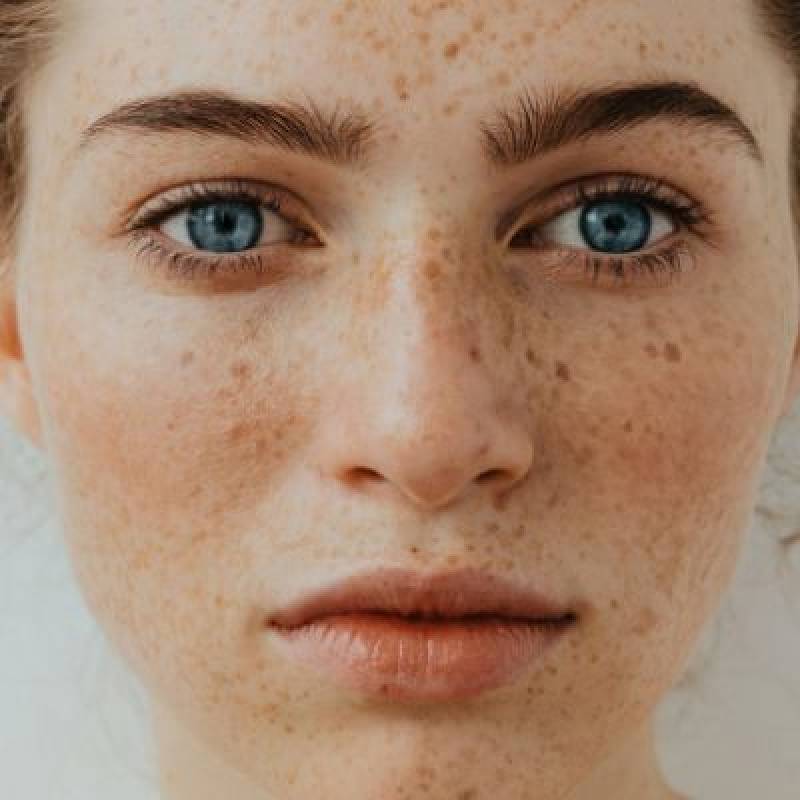 Why Your Skin Pigmentation Is Getting Worse dermoi! UK