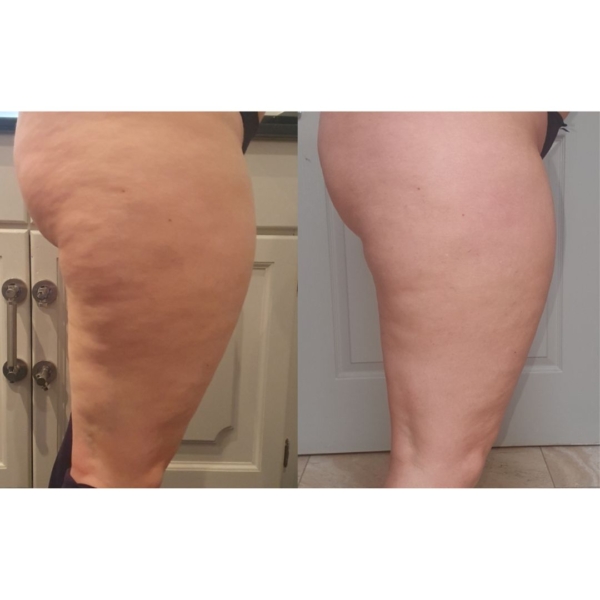 skinade cellulaite before and after dermoi!