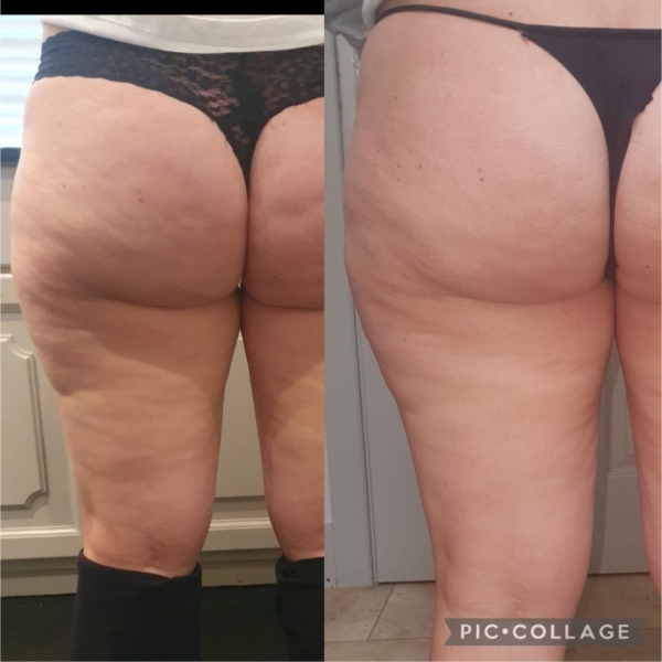 skinade cellulite before and after dermoi!